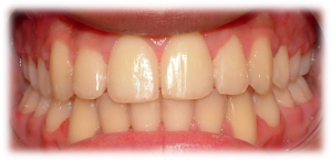 After-Image-Adol-Treatment-300x146