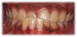 Before-Bottom-300x144