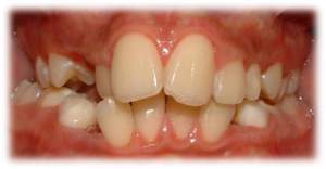 Before-Image-Adolescent-Treatment-300x156