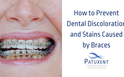Preventing Dental Discoloration and Stains Caused by Braces