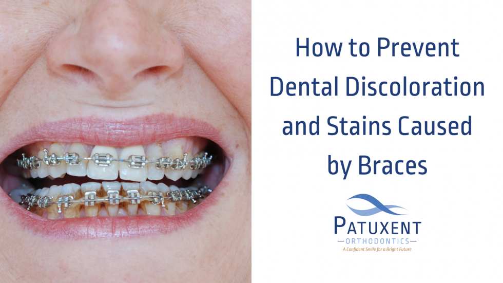 Preventing Dental Discoloration and Stains Caused by Braces
