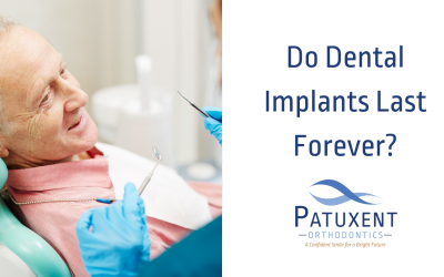 Do Dental Implants Last Forever?