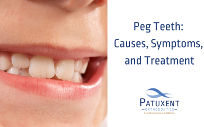 Peg Teeth: Causes, Symptoms, and Treatment