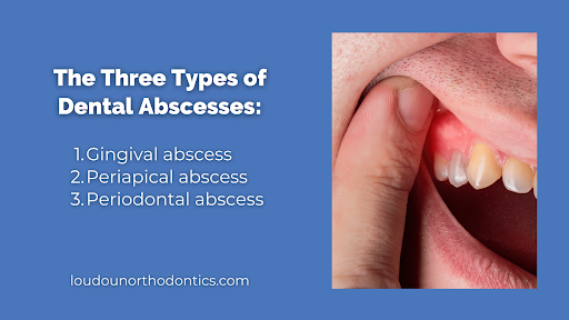 abscess gum