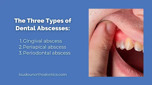 The three types of dental abscesses