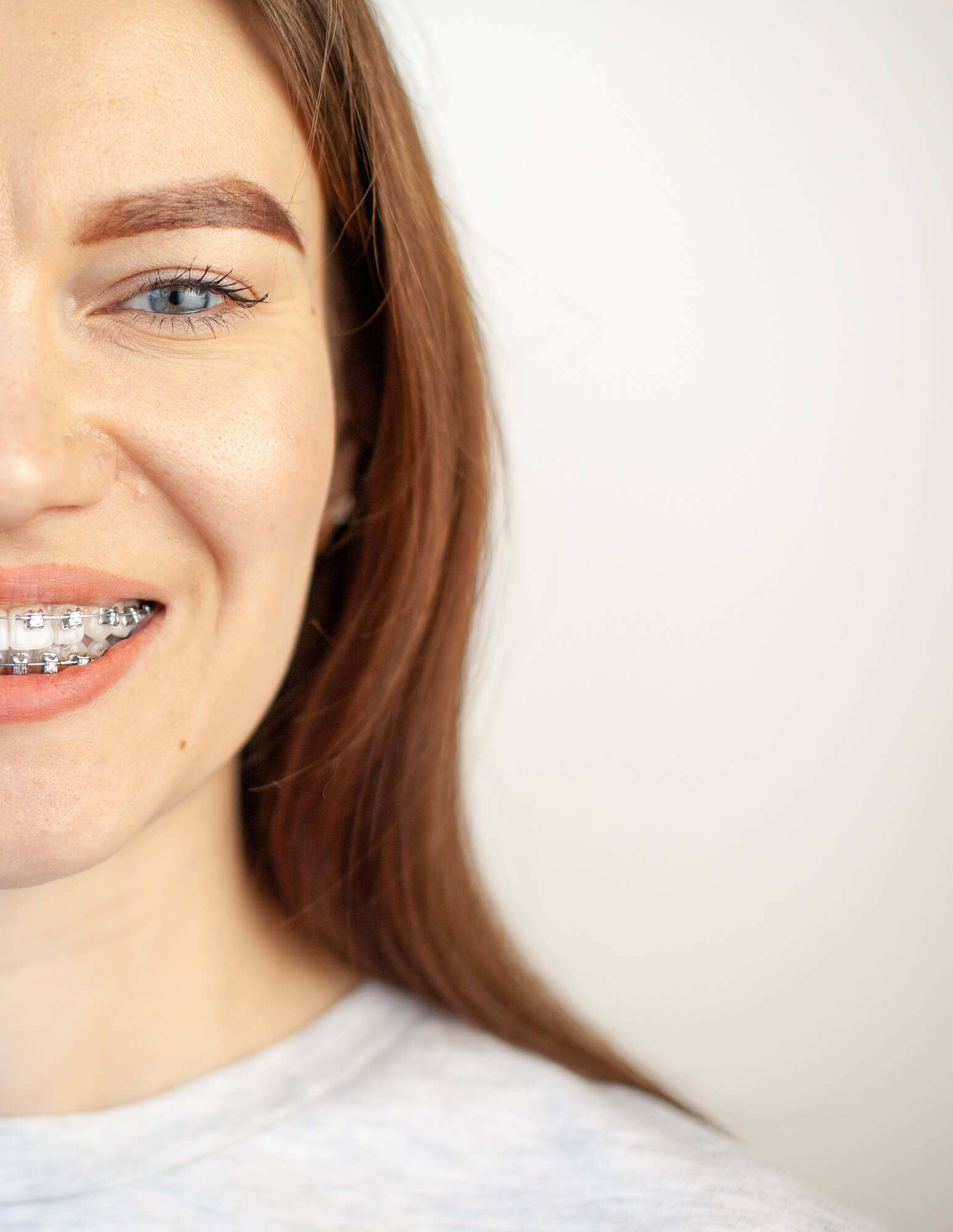 Do You Have Space-Age Wire in Your Braces? - Charleston Orthodontics  Powered By Smile Doctors