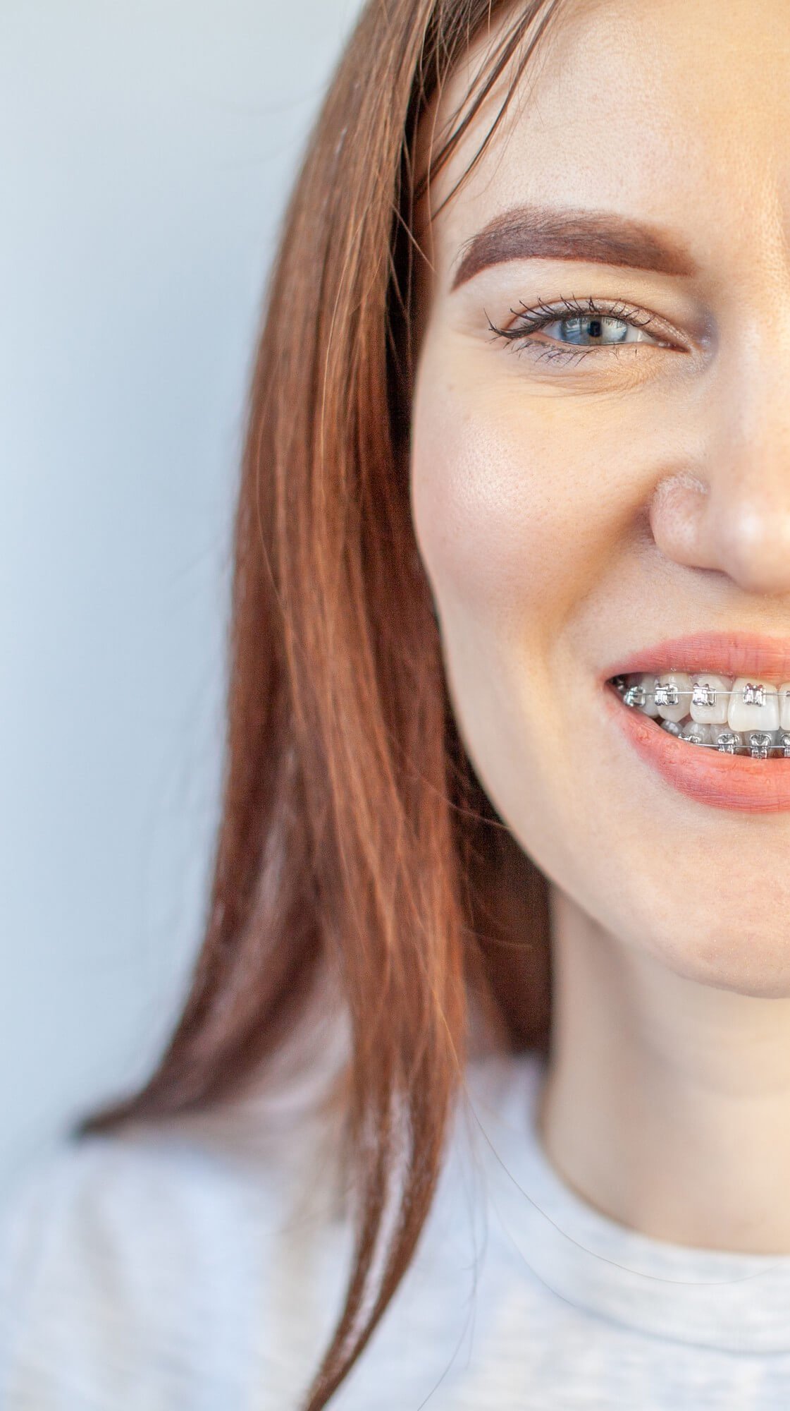 smile-young-girl-with-braces-her-white-teeth-teeth-straightening (1)