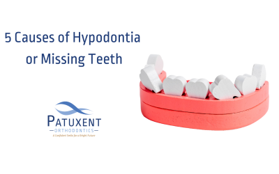5 Causes of Hypodontia or Missing Teeth