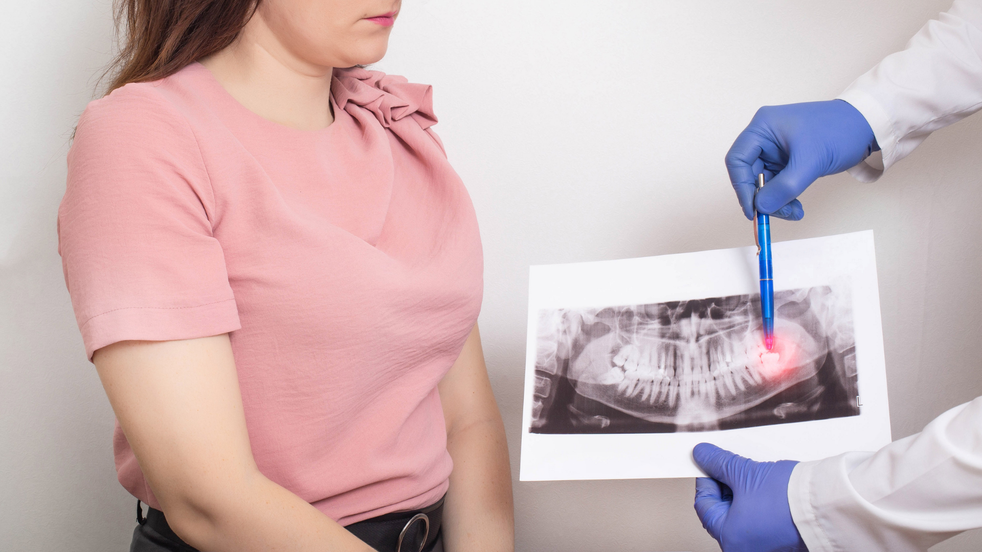 Impacted wisdom tooth X-ray