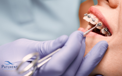 How Much Does Braces Removal Cost in Hollywood, MD?