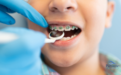 I’ve Noticed Heavy Plaque on My Braces: What to Do?