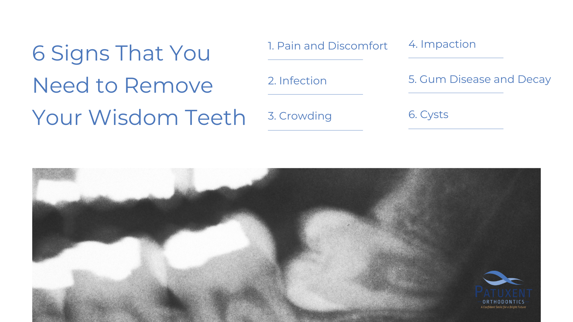 6 Signs That You Need to Remove Your Wisdom Teeth