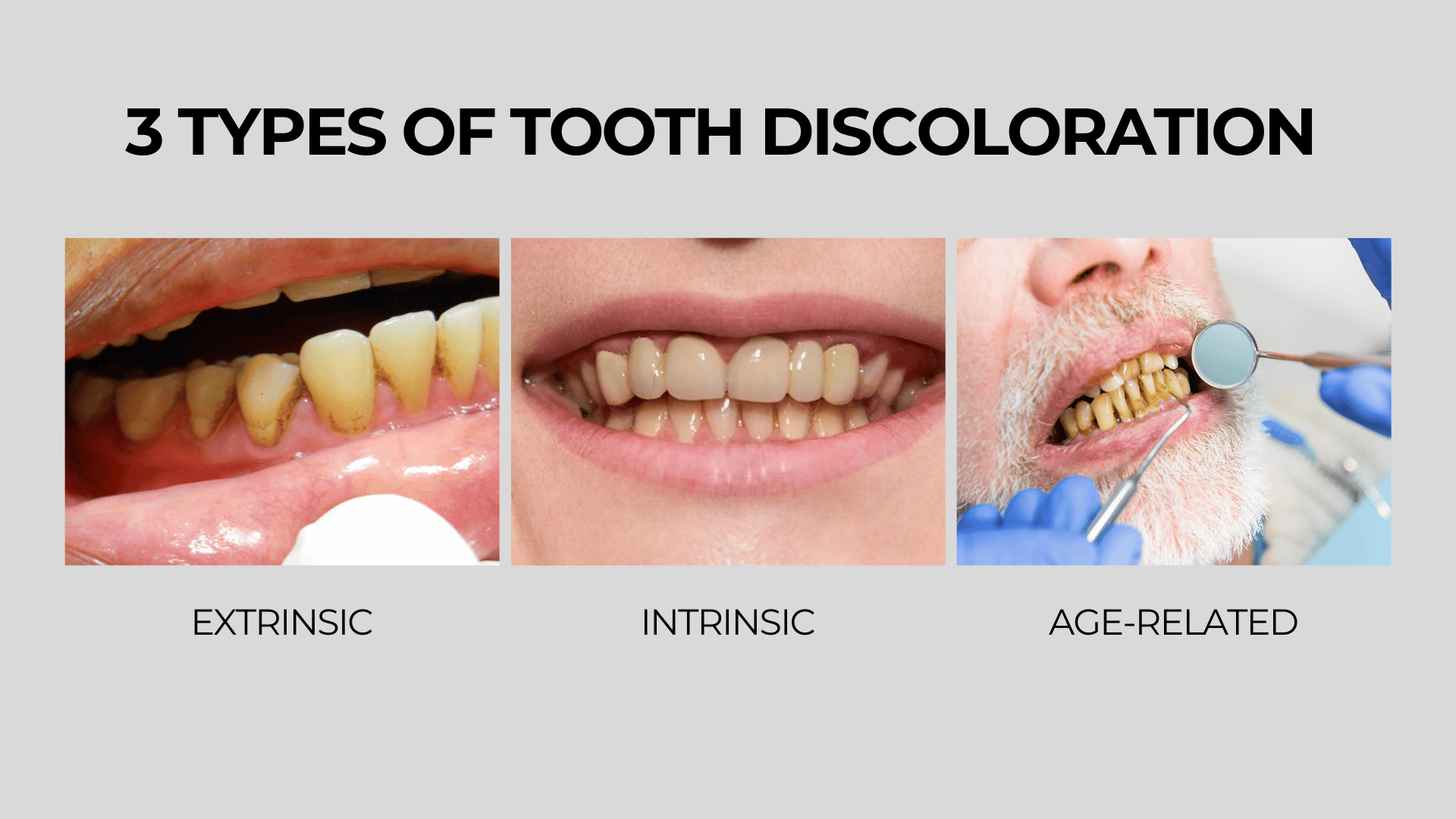 This is an infographic depicting the 3 types of tooth discoloration