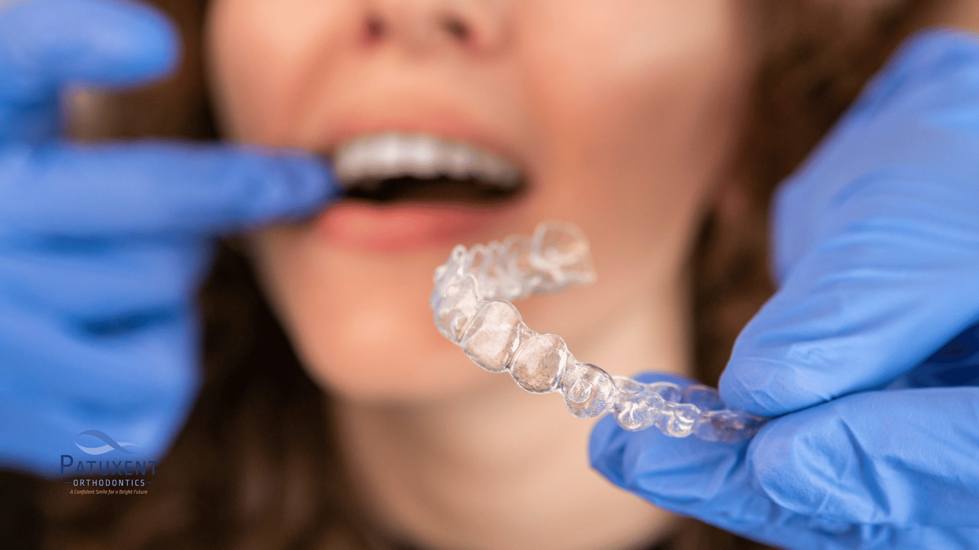 This is an image of a clear aligner with a woman in the background